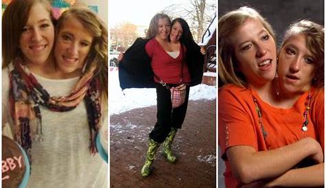 A Thorough Analysis To Comprehend The Cause Of Death For Abby And Brittany Hensel.